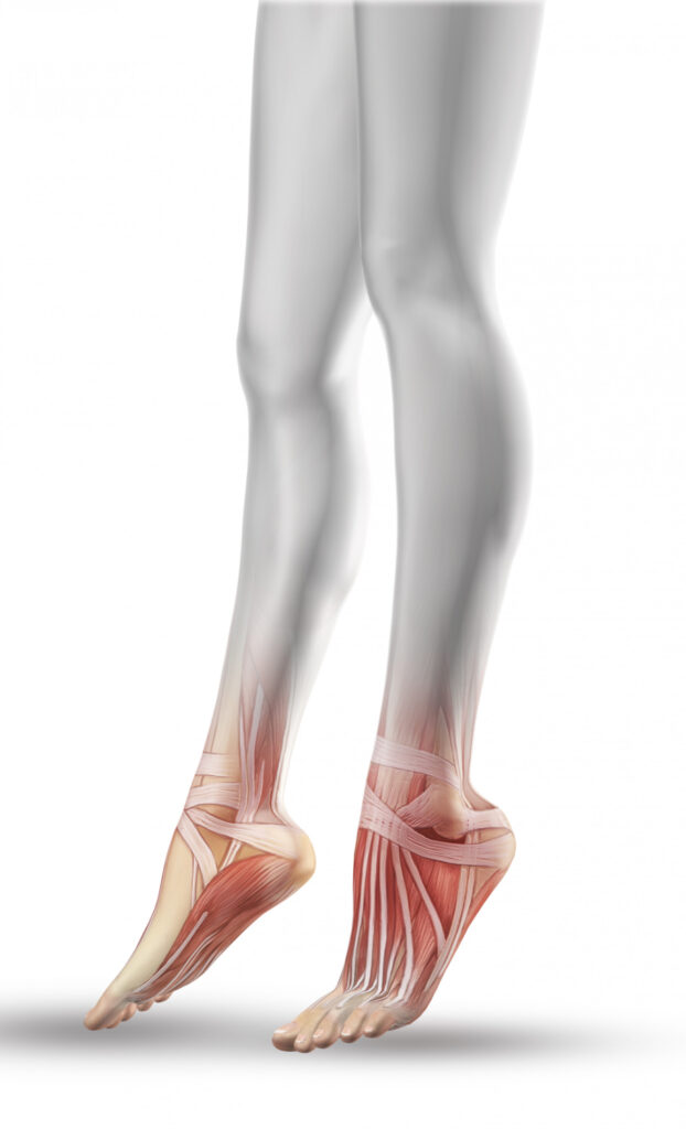 Achilles tendinopathy