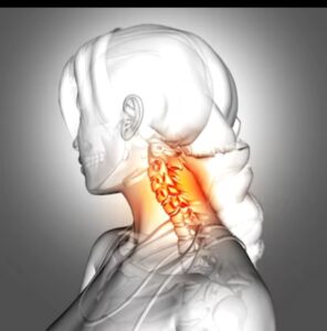 Cervical stenosis