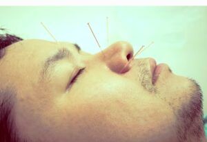 acupuncture