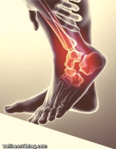 Ankle arthritis