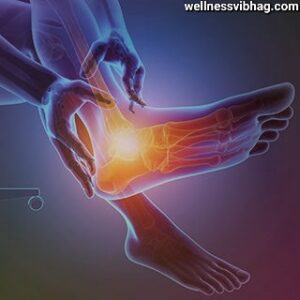 Ankle arthritis